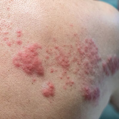 Shingles Treatment